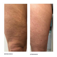 Skinade Targeted Solutions- Cellulite